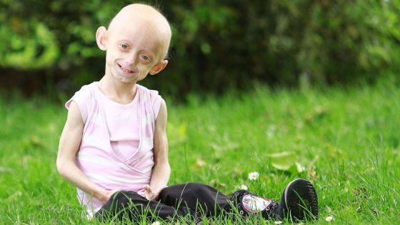 Apa Itu Sindrom Progeria Ini Gejala Penyebab Dan Faktor Risikonya